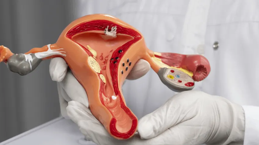 Endometriosis Fibroid Treatment Hyderabad