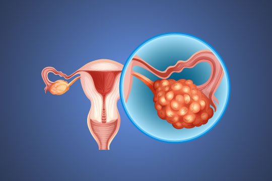 PCOD PCOS Treatment Hyderabad